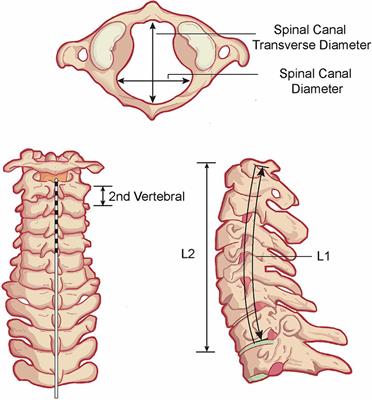 Anatomical-related factors and outcome of percutaneous short-term spinal cord stimulation electrode shift in patients with disorders of consciousness: a retrospective study